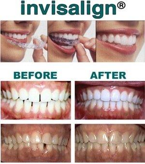 INVISALIGN