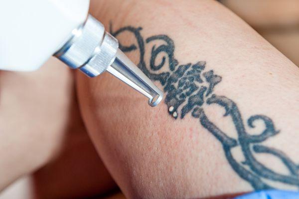 Laser Tattoo Removal NYC