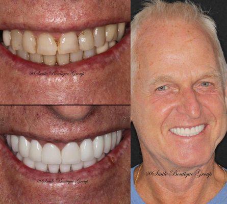 Dental Implants at Smile Boutique