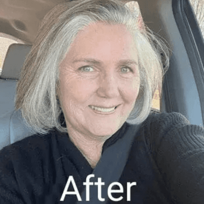 After Sublingual GLP-1 Semaglutide Medication