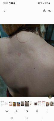 ATROPHY AFTER INJECTIONS