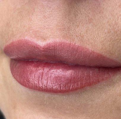 Our Russian Lips with Juvederm