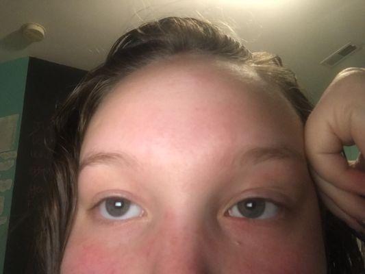 The stye under my left (right in the picture) eye