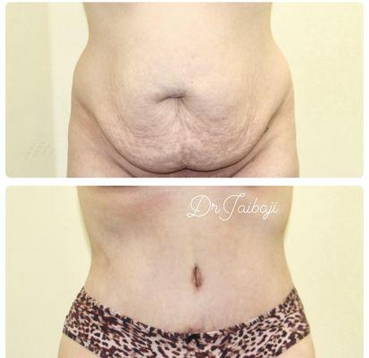 Tummy tuck and liposuction