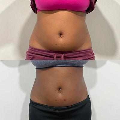 Before and after body treatment package