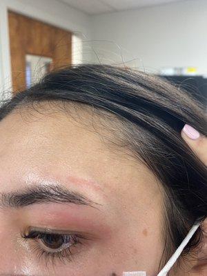 Burn from eyebrow wax