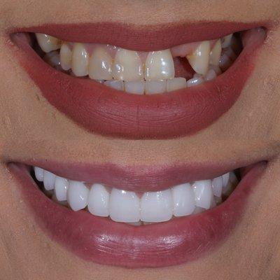 Porcelain veneers before/after!