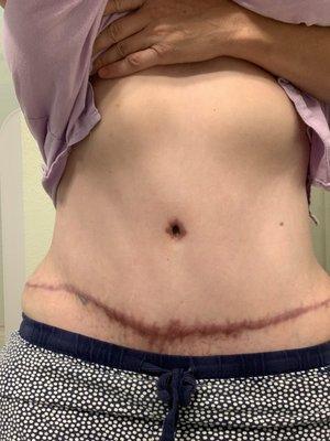 Extended tummy tuck. My skin reacts very bad, if you remember to rest like Dr says, outcomes will be much better!