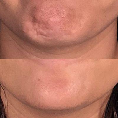 Dysport injection to smooth chin bumps.