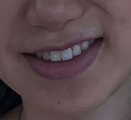 Fixed the discoloration from braces on my 2 front teeth!