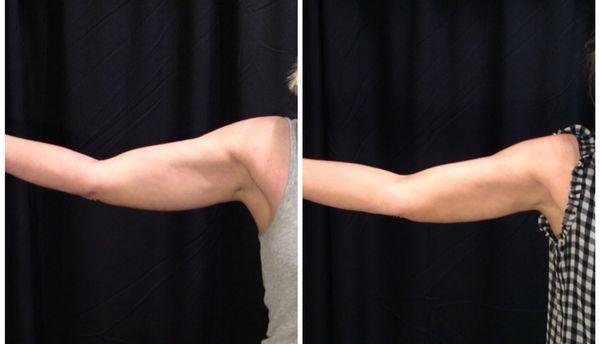 CoolSculpting Arms after 60 days