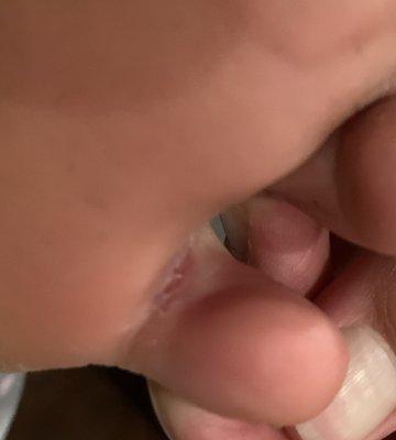 Cut between my toes