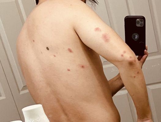 Bed Bug bites