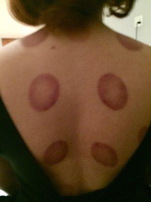 Cupping $10