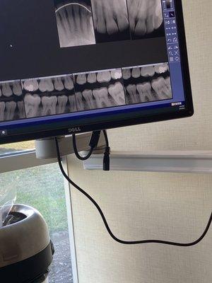 Nobody trying to explain any problem areas from x-ray!  I was told from the male dentist my teeth was fine, all looked good.