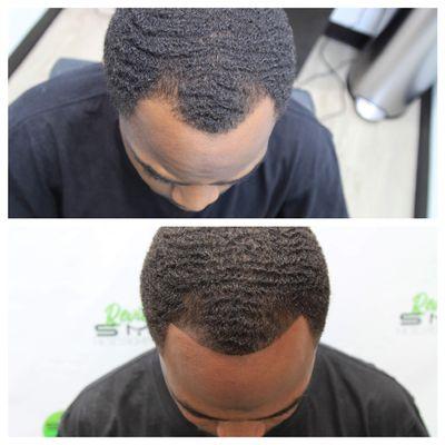 Before and after Scalp Micropigmentation hairline restoration