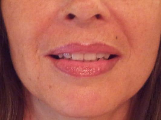 Lips after Feathering... immediately following procedure - Permanent Lips/Feathering in "nude"