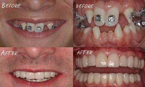 Congenitally Missing Teeth; Full Mouth Reconstruction/Rehabilitation.