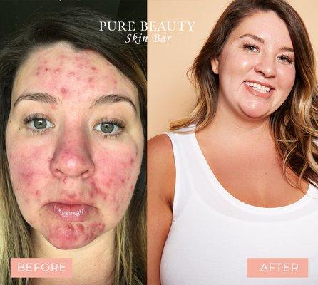 Are you suffering from Acne? Let us help you get clear skin! Sign up for the Acne Bootcamp At www.purebeautybarcincy.com