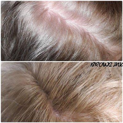 SCALP MICROPIGMENTATION FOR THINNING AREAS