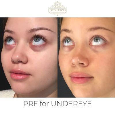 Treatment undereye with PRF (Platelet-rich-fribrin) to stimulate collagen and improve the undereye area.