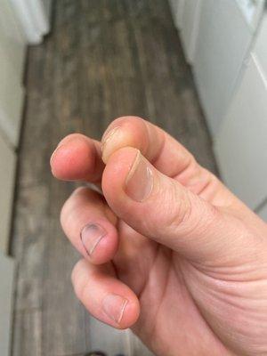 Fungal infection under nails