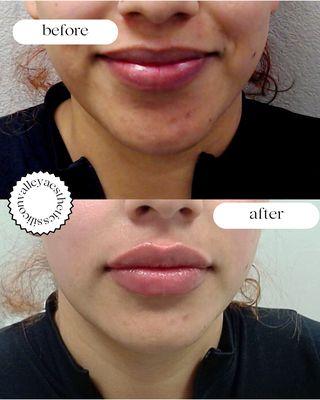 Juvederm lip filler, before an after, done by our wonderful staff!