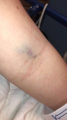 my arm after the IV