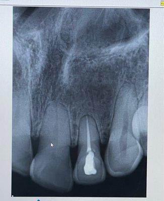 My root canal done with expertise!