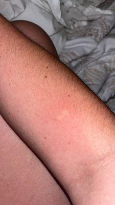 Bug bite