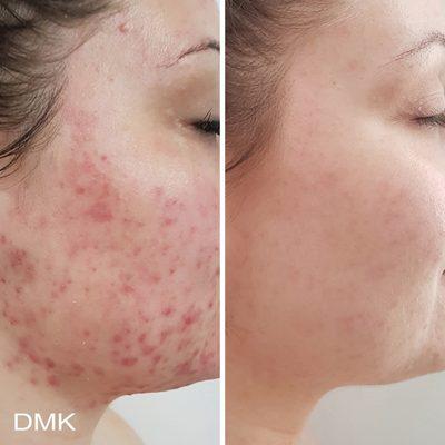 DMK Skin revision acne treatment