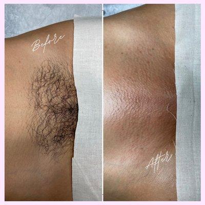 Before and after results of a Brazilian wax.