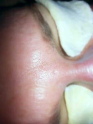 After only one treatment of the bio-needling facial. ..amazing results. .