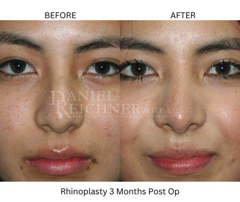 Rhinoplasty Before & After 3 Months Post Op