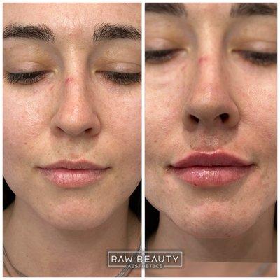 Lip Filler Before and After