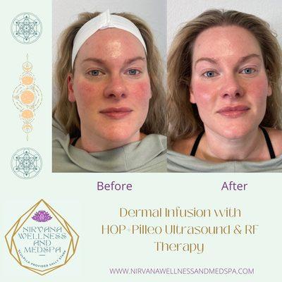 Dermal Infusion with HOP+Pilleo, utilizes stem cells and PLLA Filler to rejuvenate the face, neck and décolleté!