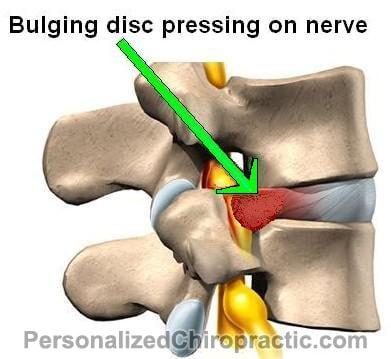 Get a low cost exam to see if you have a bulging disc.