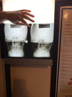 The before on the right, first treatment on the left. Off to a great start.