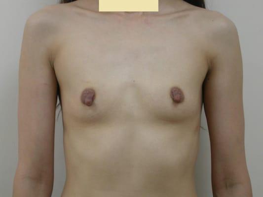 Patient with little breasts and sagging nipples.