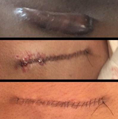 Surgeon removal of keloid