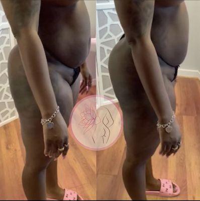 This beauty wanted a rounder bum and loose inches for her abdomen. Look at her amazing results after her first session.