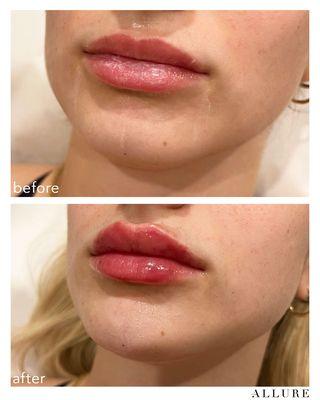 lip filler