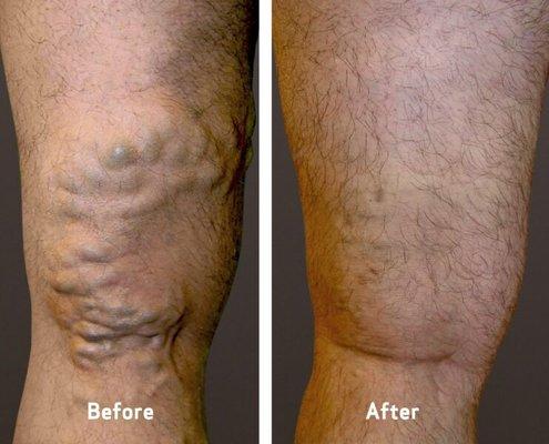 Before and After at USA Vein Clinics