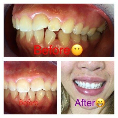 Before and After Smile