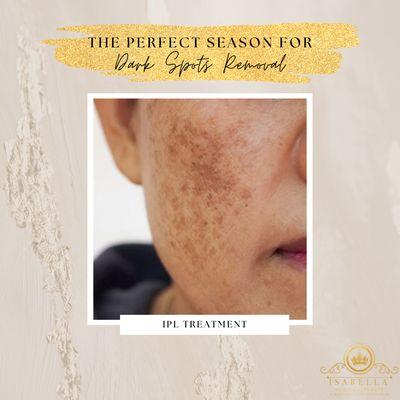 Dark spots removal with ipl