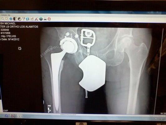 Michael P's new Titanium hip; excellent job by Dr. Ahn MD.