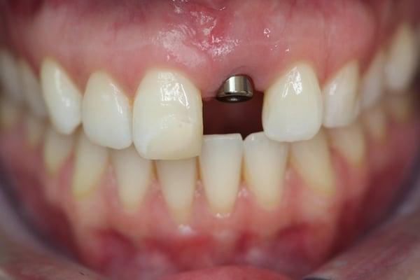 Before photo of an implant case.  The missing tooth and the adjacent tooth were restored with  porcelain crowns.