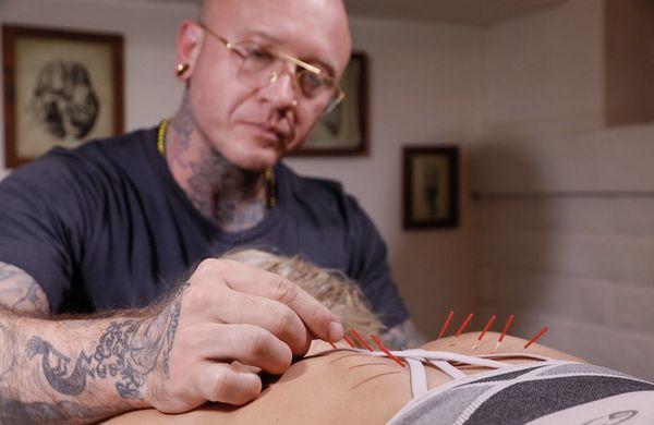 Acupuncture for neck pain.