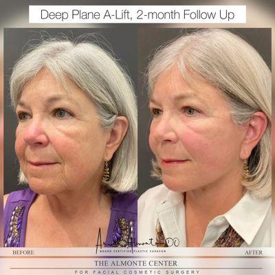 B/A: A-Lift, Dr. Almonte's signature facelift