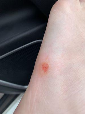 Skin scrapped from side of foot during scrub